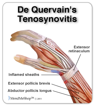 De quervain's tenosynovitis corticosteroid injection